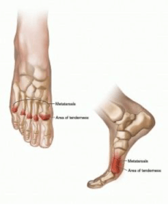 Podiatry | 1 Inflammation of the joint capsule at the junction of the metatarsal bone and toe capsulitis MTP joint | 3D VCN