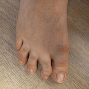 Podotherapie | Chronisch uit de kom gaan subluxatie van tenen | 3D VCN